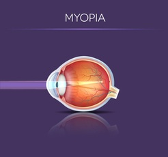 Myopia Example